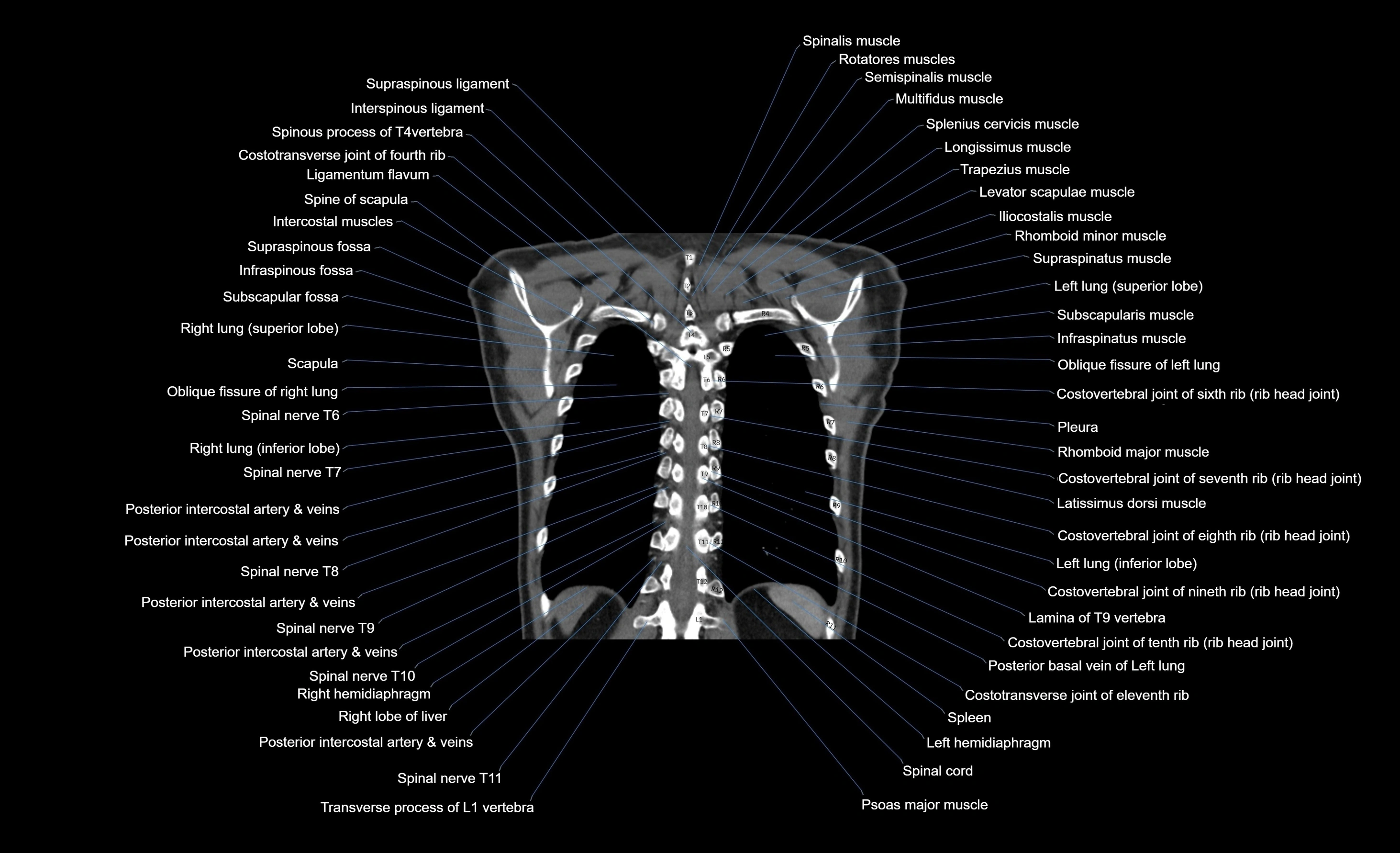 CT chest (thorax) soft tissue window labelled coronal cross sectional anatomy radiology image-00025.webp
